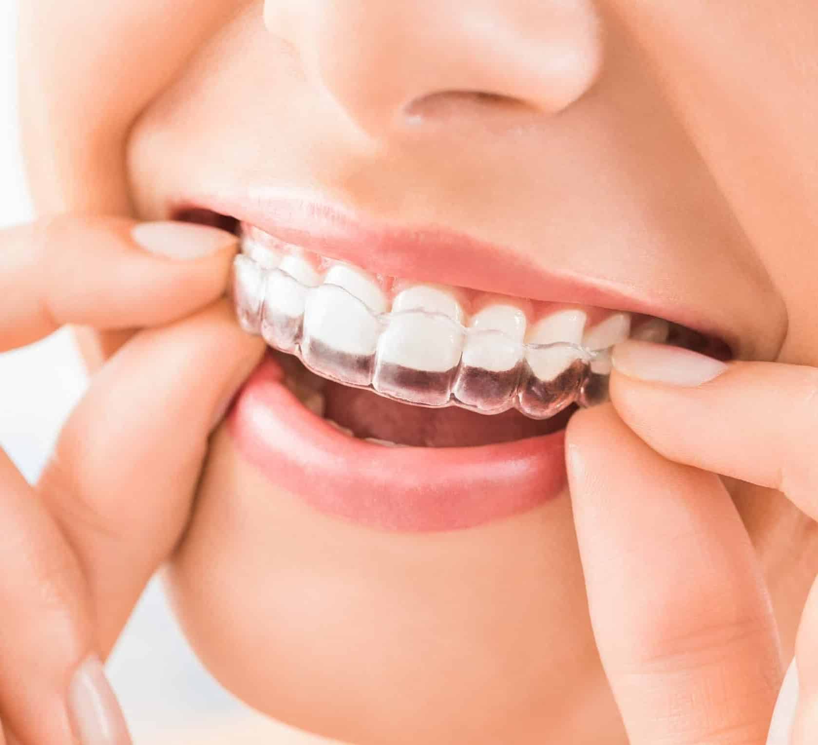 https://theentiresolution.akstudiobiz.com/wp-content/uploads/2024/06/invisalign-applying.jpg