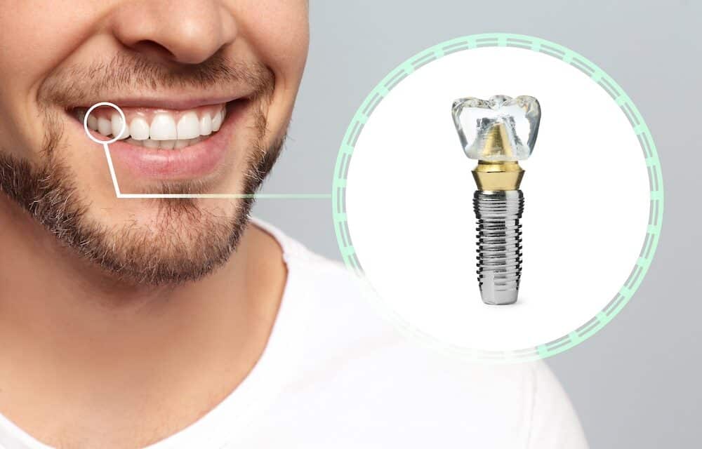 Dental Implant Healing Stages: Your Guide to Recovery Success