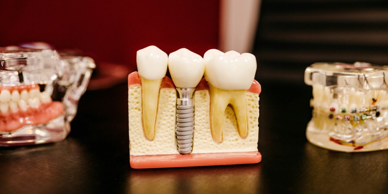 How Dental Implants Work: A Guide to Tooth Replacement
