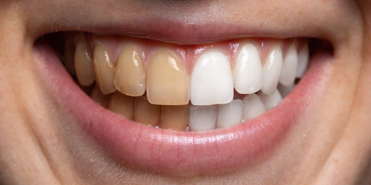 Tooth Stain vs Cavity: Key Differences You Should Know