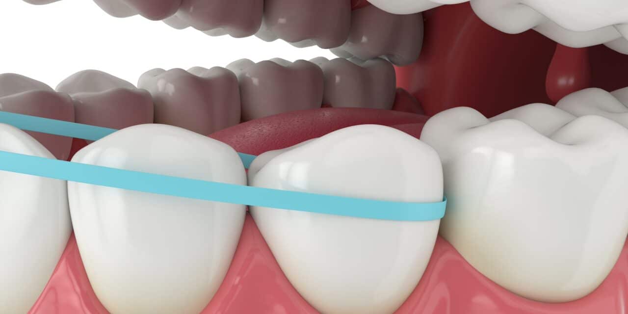 Gingivitis Self-Care: Essential Tips for Healthy Gums