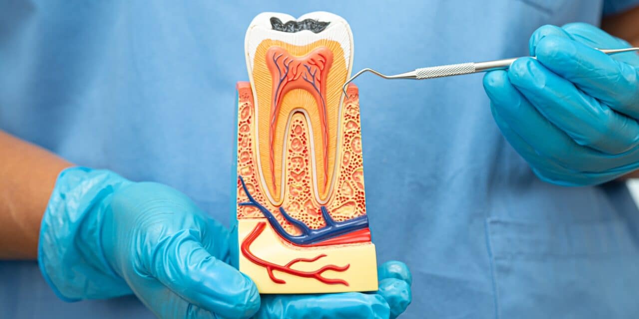 Root Canal vs Cavity – What’s the Critical Difference?