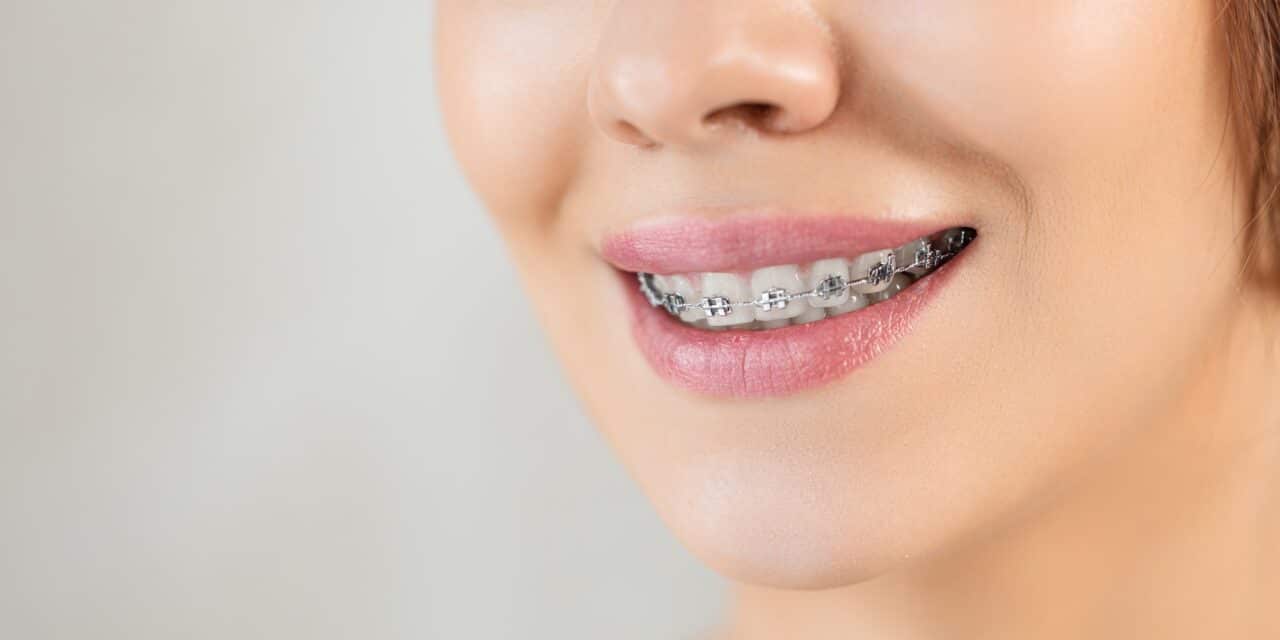 Braces for Adults: Your Complete Guide to Treatment Options