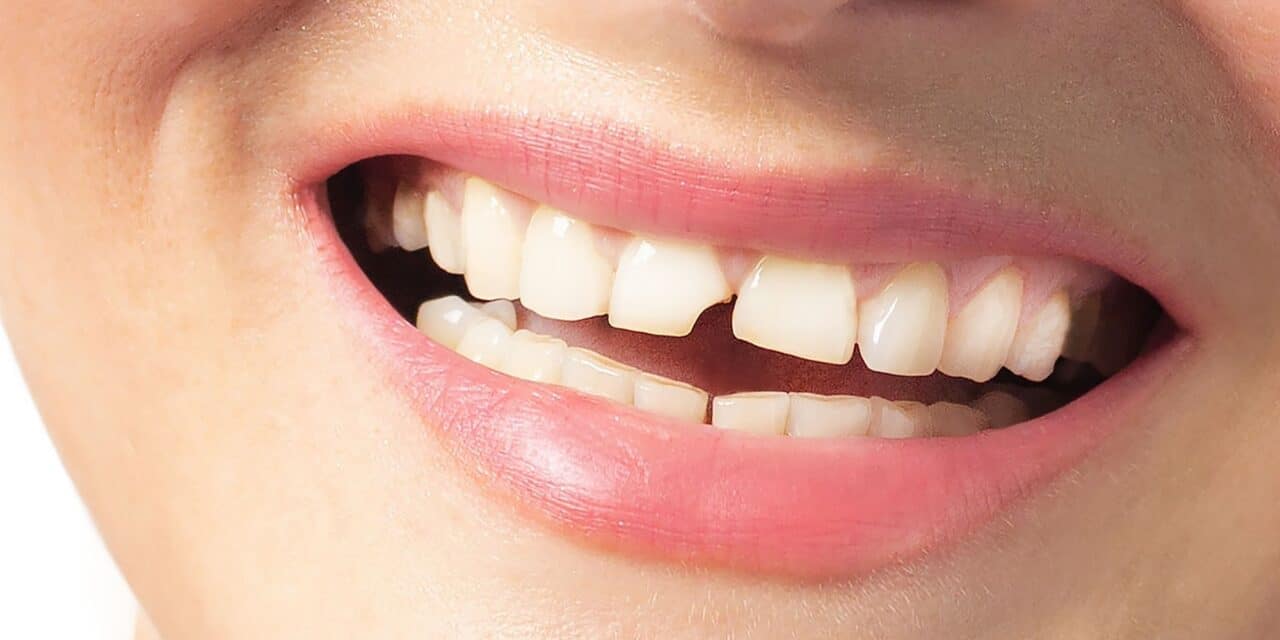 Can a Chipped Tooth Grow Back? Expert Guide