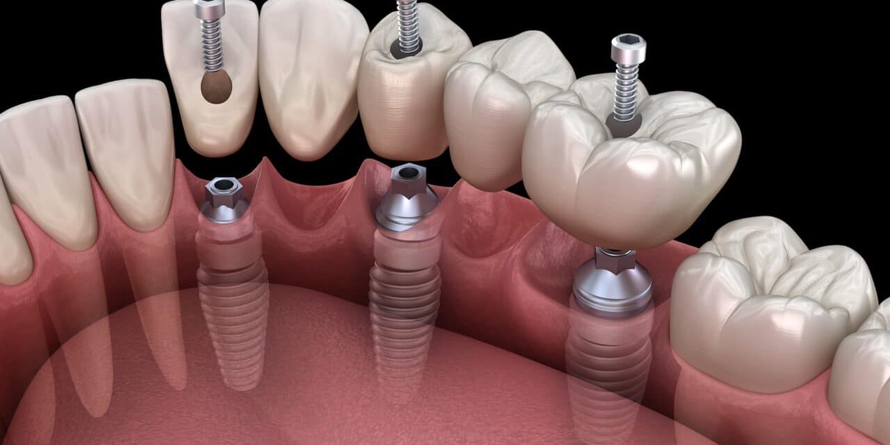What Are Teeth Implants Made Of? Materials Guide 2025