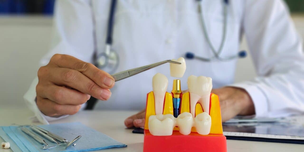 How Are Dental Implants Done? A Step-by-Step Guide