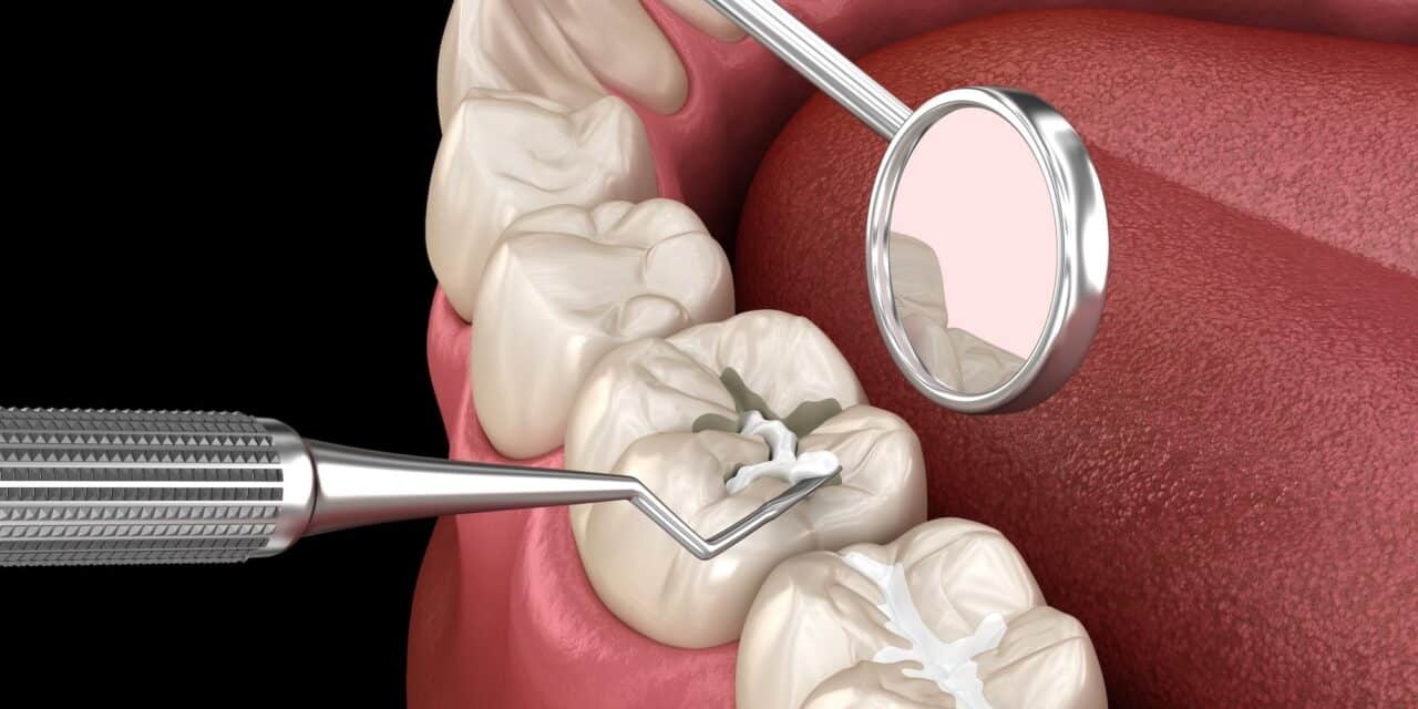 Does Replacing a Filling Hurt? Dentists Reveal the Truth