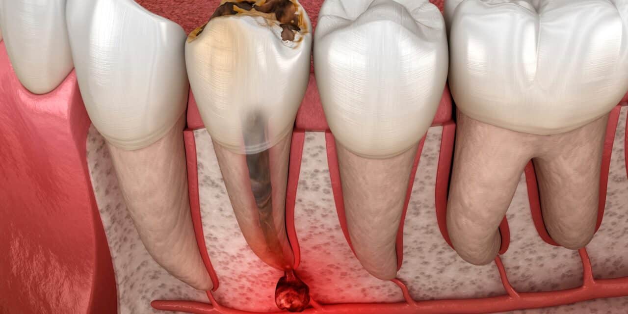 Root Canal Infections: Why They Return Years After Treatment