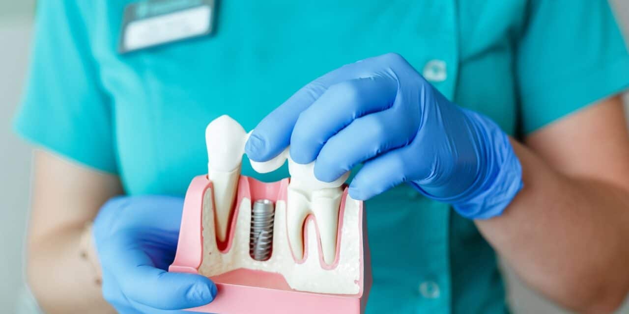 Molar Implants: The Modern Solution for Missing Back Teeth