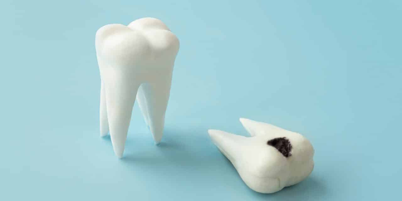 Stages of Tooth Decay: Spot Warning Signs Before Damage Strikes