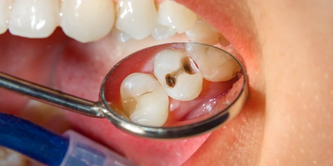 Why Do Cavities Hurt? A Dentist Explains the Painful Truth
