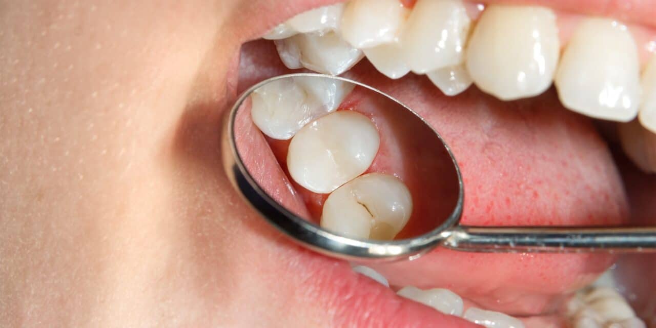How Long Do Cavities Take to Form? The Silent Timeline Revealed